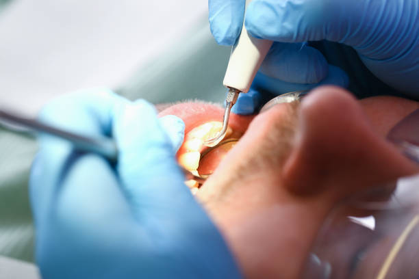 Best Knocked-Out Tooth (Avulsed Tooth) Treatment in Sullivan City, TX