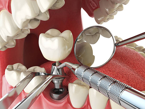 Best Lost Filling or Crown Replacement in Sullivan City, TX